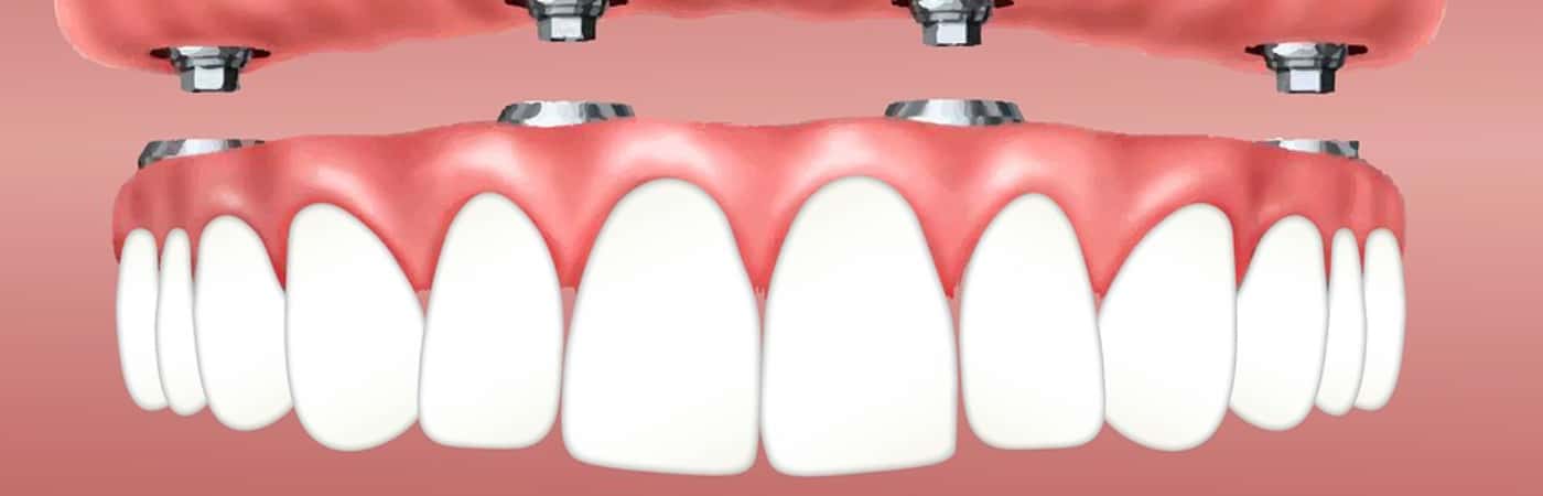 Perfect Teeth At Last With Affordable Dental Implants
