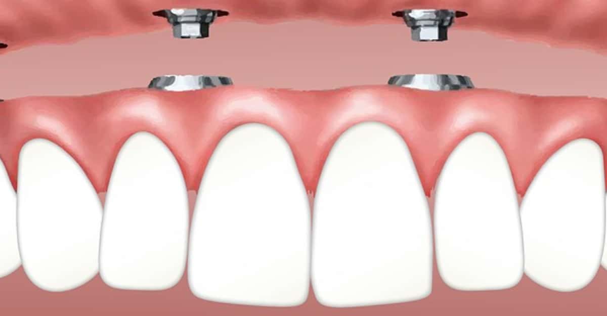 Perfect Teeth At Last With Affordable Dental Implants