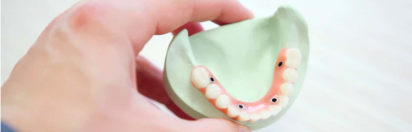 Find Cheap Dental Implants In 2020